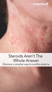 Eczema – Itching for a Solution Eczema isn't just dry skin; it's a dynamic, chronic condition* that often requires lifelong management. Flare-ups, itching, and inflamed patches can disrupt sleep, daily routines, and confidence. And while steroid creams might offer temporary relief, they don't address the full picture. Eczema needs a comprehensive strategy that includes barrier repair, identifying internal triggers, managing allergies, and even stress support. It's about calming the inflammation 