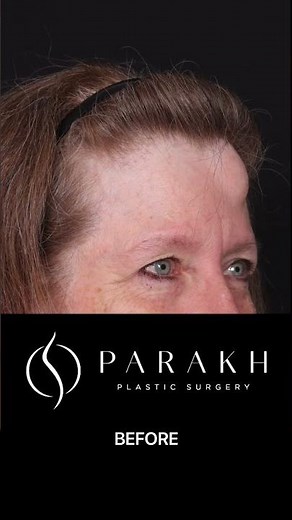 Before & After Forehead Lipoma Removal | Smooth, Clear Results