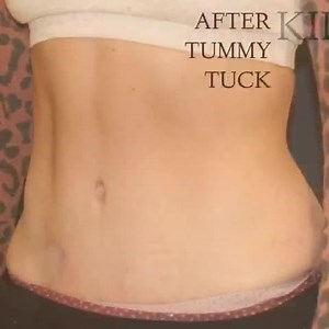 Fitness Tummy Tuck