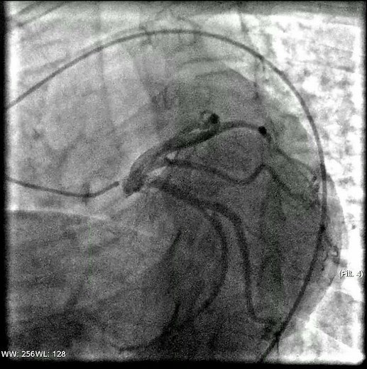 Coronary angiography video. Operation.