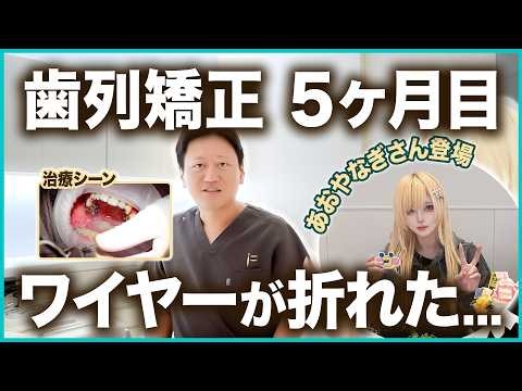 【治療シーン】ワイヤーが折れた... 歯列矯正5ヶ月目の矯正のリアル【ワイヤー矯正 あおやなぎ 青柳なぎ】