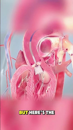 TAVI Heart Valve Replacement Explained (3D Animation)#3danimation #medicaleducation #healthcare #fyp