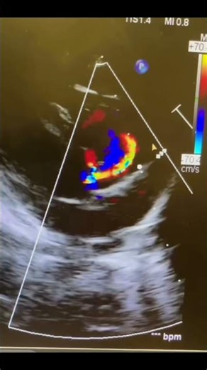 Moderate perimembranous VSD with L→R shunt (color Doppler)