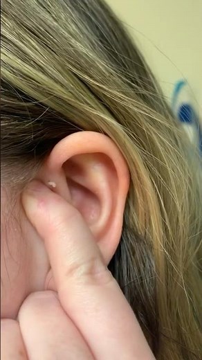 Ear pit ear sinus preauricular pit
