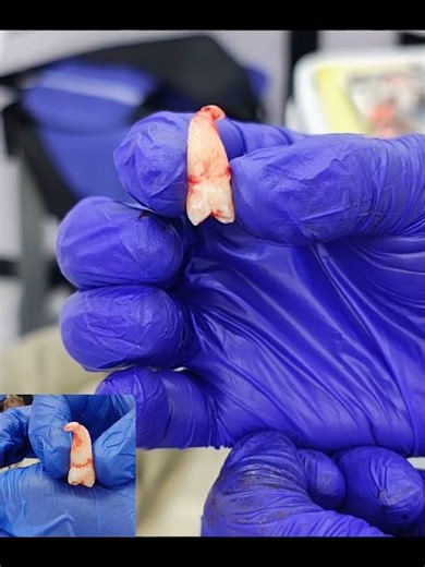 #dentist #dentalcare #dentalextraction #toothextraction #toothremoval #tooth #adidentalcare