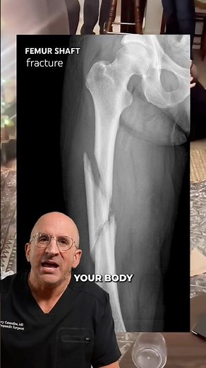What Happens When You Break Your Thighbone?