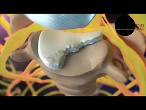 VOID Cleveland Clinic AD Anterior Cervical Discectomy and Fusion Medical Animation