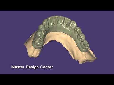 Implant hybrid bridge design - Exocad