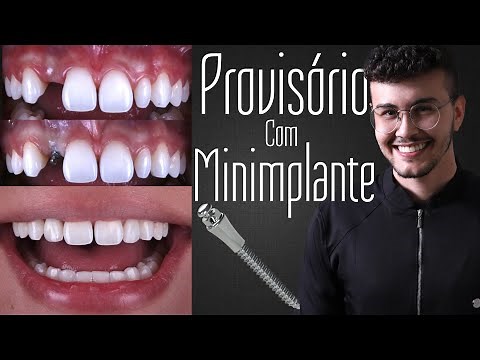 Temporary tooth with orthodontic mini-implant? How to do it?