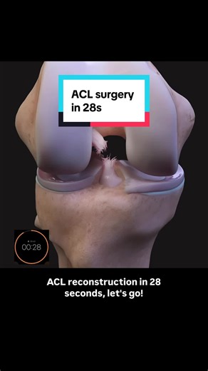 Understanding ACL Reconstruction: Trusting the Process