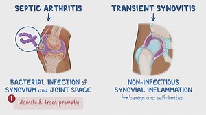 Video: Septic arthritis and transient synovitis (pediatrics): Clinical sciences - Video Explanation! | Osmosis | Osmosis