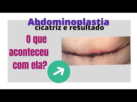 Cicatriz e resultado de abdominoplastia: o que aconteceu com ela?
