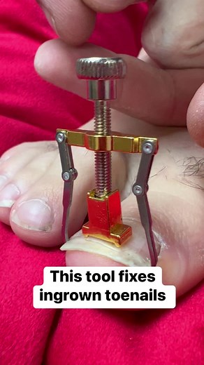 53K views · 94 reactions | This is how to fix an ingrown nail | The Ryan And Amber Show | Facebook