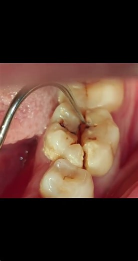 Cracked tooth #OralHealth #OralHealth #LoveYourTeeth #DentistRoutine #ProtectingYourTeeth