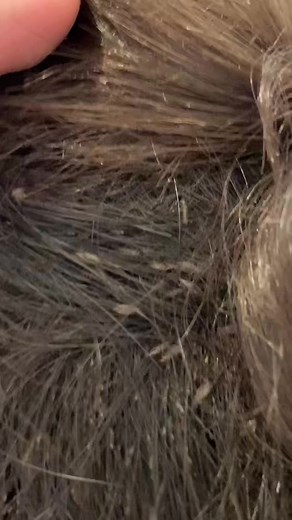 POV my thoughts during work #licetok #trashywashyy #headlice | lice removing