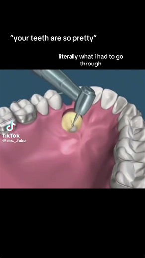 Understanding Impacted Canines and Their Treatment