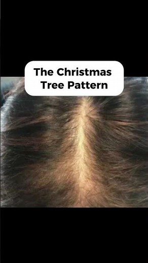 DHT Hair Loss Signs Most People Ignore (Early Warning Patterns)