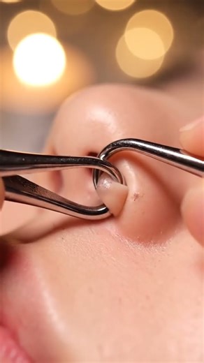 “Unreal Blackhead Extraction — The Perfect ASMR!”