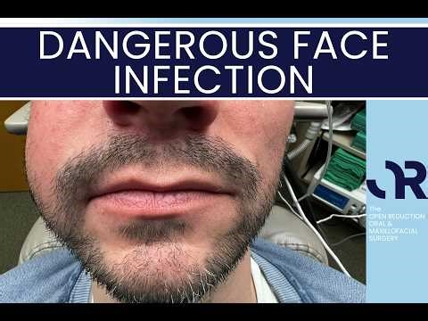 DANGEROUS FACE INFECTION from CRACKED TOOTH