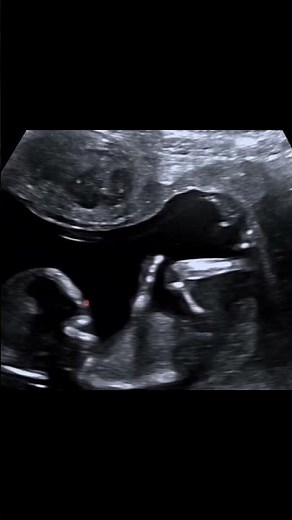Intramural fibroid in the first trimester of pregnancy