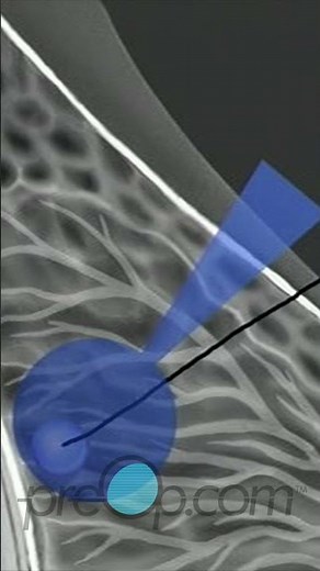Breast Biopsy Wire Localization: Step-by-Step Guide 🏥 🎥 #PreOp #Shorts #BreastBiopsy Pt. 3