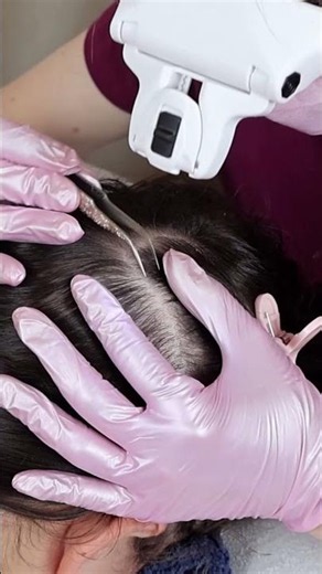 ASMR School Nurse LICE Check on Scalp and Nape | Lice Removal with Tweezers #short #asmr #shorts