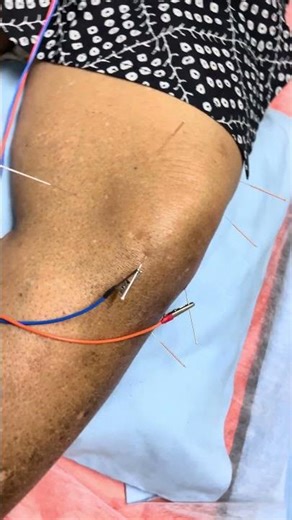 Knee Pain & Ligament Injury Relief TherapyDry Needling for Knee Ligament Tear Recovery