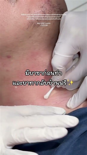 จี้ไฝ จี้ขี้แมลงวัน ที่เพอร์โซน่า คุณหมอดูแลเองทุกเคส! #fyp #จี้ไฝ #จี้ขี้แมลงวัน #จี้กระเนื้อ