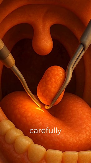 Tonsillectomy Surgery _ Explained #animation