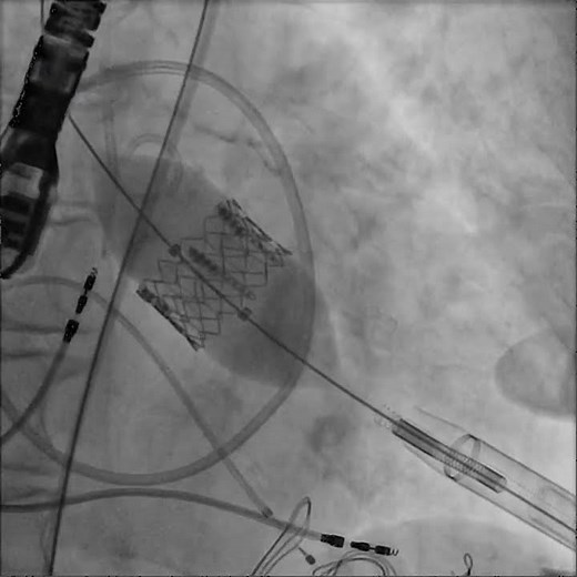 TAVR-Transcatheter Aortic Valve Replacement: Transapical Deployment