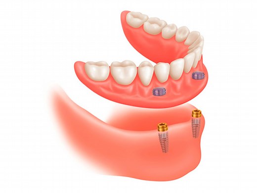 Sobredentadura con implantes: ¿Qué cuidado y mantenimientos necesita?