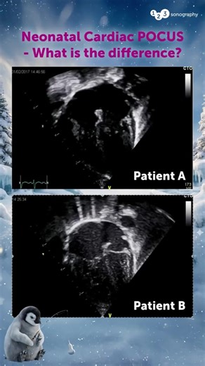 The apical 4-chamber (A4C) view is fundamental for assessing ventricular size and function. However, neonatal hearts are somewhat unique, and so are their diseases 🥴✍️ Look at the echo loops of routine neonatal cardiac scans of these two neonates. 🧐 What is the most likely clinical difference between these two patients? A) Patient A (top) shows a dilated LV B) Patient B has Pulmonary Hypertension C) Patient A is likely several days older or more "mature" Comment what you think! We can help you