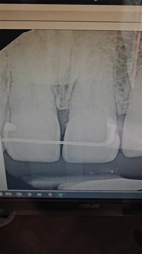 Okay so let me show you something wild I saw today… This patient came in with zero pain. No trauma. No discoloration. Tooth looked completely normal. Just some inflamed tissue on the lingual it all seemed innocent Like… innocent. Suspiciously innocent. 😅 I wanted to take an X-ray to make sure it was just a tissue issue and BOOM — internal root resorption. Now if you don’t know what that is, it’s basically when the inside of the tooth starts breaking itself down. Yes. The tooth said, ‘I’m gonna 