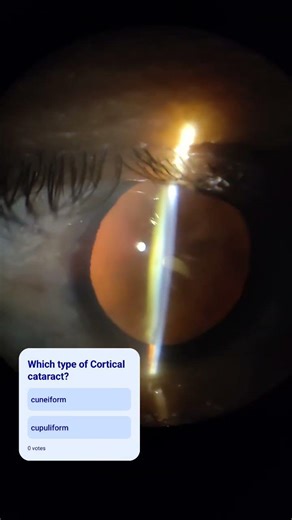 Cortical Cataract- occurs due to overhydration of lens #eyehospital #eyevision #opthalmologist