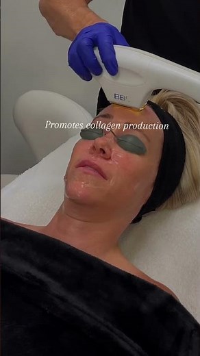 What are the benefits of a bbl laser treatment?
