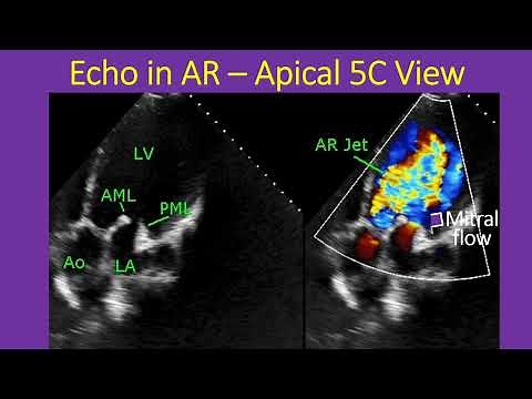 Echocardiographic evaluation in aortic regurgitation