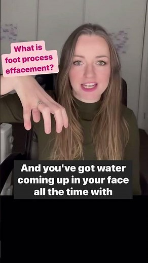 Podocyte Foot process effacement - learn GN Glomerulonephritis for RACP MRCP USMLE Exams