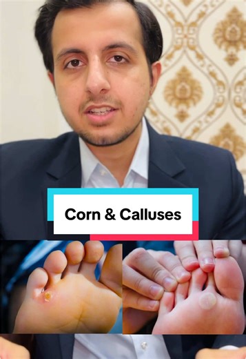 Corns and Calluses Treatment for Better Foot Health