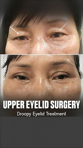 Upper Eyelid Surgery Before and After #eyelidsurgery