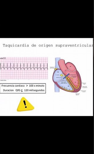 Caracteristicas y Diagnostico de las Taquicardias Supraventriculares de Complejo - Dr Jose Porto