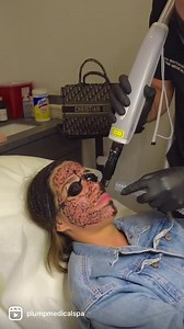 Carbon Laser Peel