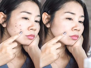 Dark Spots : மறையவே மறையாத கரும்புள்ளியும் காணாம போக இந்த வீட்டு வைத்தியத்த ட்ரை பண்ணுங்க...