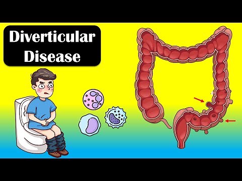 Diverticular Disease And Diverticulitis - Causes, Signs & Symptoms, Diagnosis, Treatment