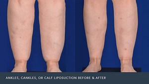Calf and Ankle Liposuction | Phoenix Liposuction
