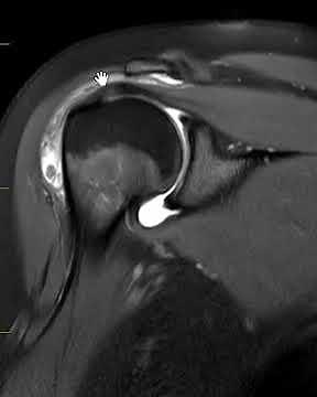 Bursitis of shoulder | First Look MRI