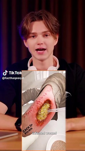 infected wound facts #FunFacts #DidYouKnow #FactOfTheDay #TriviaTime #KnowledgeIsPower #MindBlown #FactCheck #InterestingFacts #RandomFacts #FactFriday #Reels #Trending #Viral #Explore