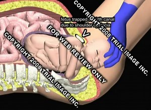 Zavanelli maneuver to relieve shoulder dystocia video Animation by Cal Shipley, M.D.