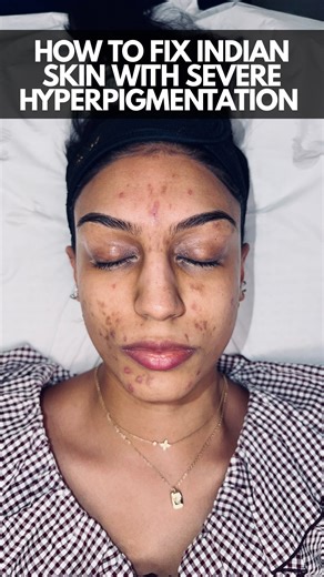 LETS FIX SEVERE HYPERPIGMENTATION ON INDIAN SKIN! Clients from South Asia suffer much more from hyperpigmentation usually due to their melanin production, this means acne & trauma almost always leaves a dark mark after it subsides Using our in house laser we can effectively treat this Hyperpigmentation with the right settings for south asian skin & remove the TOUGH DARK SPOTS #london #asianskin #hyperpigmentation #pigmentation #darkspots #darkmarks #brownskin #blackskin #reel #viral #explore | B
