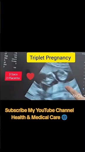 Triplet Pregnancy Ultrasound #triplets #triple #pregnancy #baby #ultrasound #twins #anomalyscan #yt