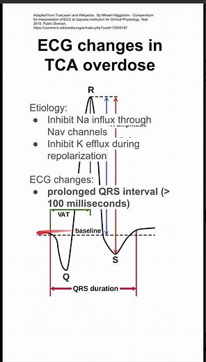Electrocardiography (EKG) changes in tricyclic antidepressant overdose
